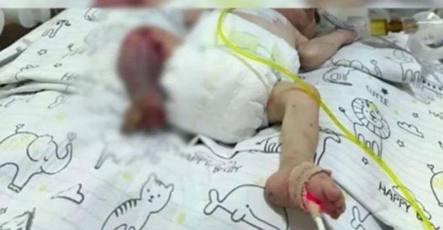 Ömer bebeğin bacağına ne oldu? Özel hastaneye yanlış uygulama suçlaması