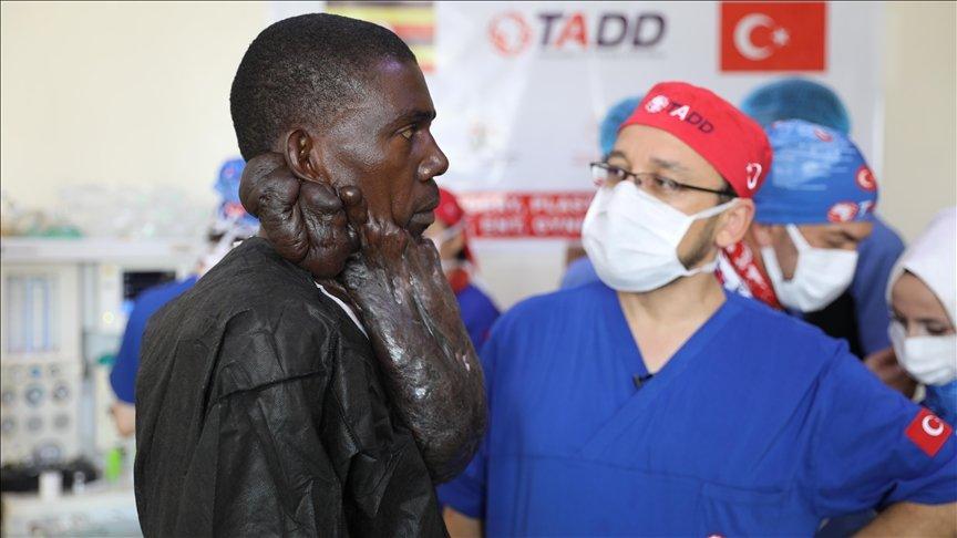 Ugandalı hasta, yüzündeki 5 kilogramlık kitleden Türk doktorlar sayesinde kurtuldu
