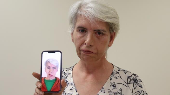 Yüz felci sonrası gözünü kapatamayan hastaya altın implant tedavisi