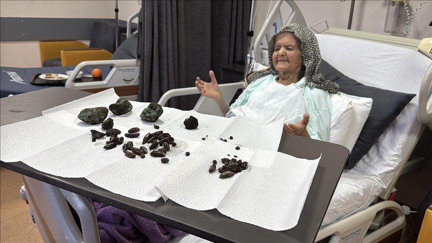 Midesinden 28 hurma, 35 zeytin çekirdeği ve 5 taş çıktı