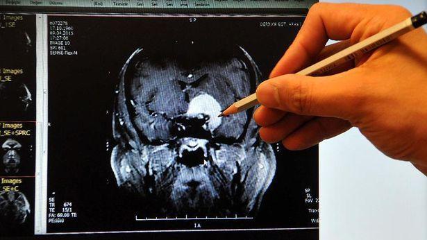Trigeminal nevraljiye 'sinir blokajı' ile müdahale hastalara umut oldu 