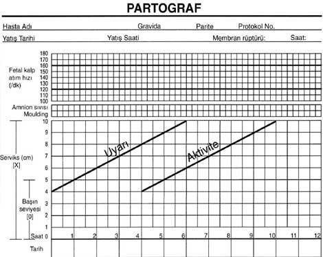 Keyfi sezaryene 'partograf' engeli... 