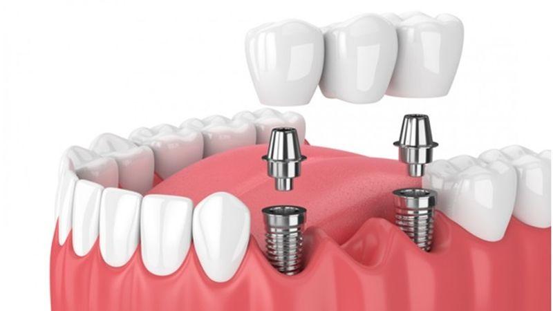Diş implantı tedavisi kimlere uygulanır?