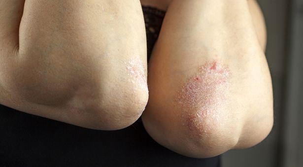 Sedef romatizması hastaları güneşten faydalanırken dikkatli olmalı