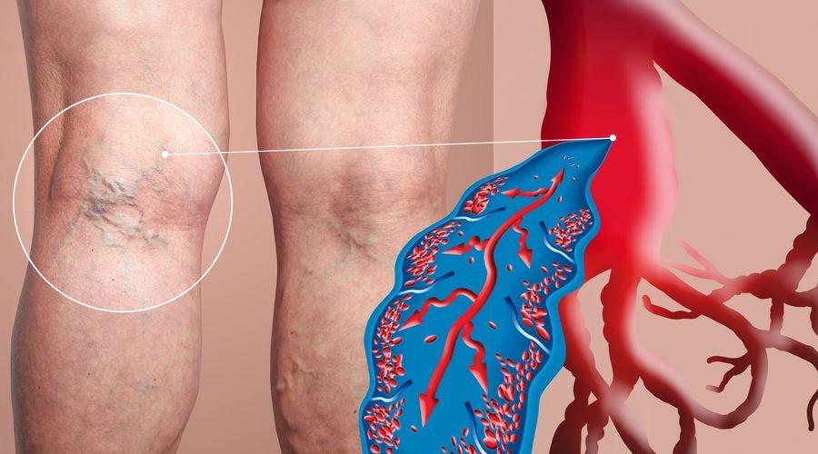 Hormonal değişiklikler varis oluşumunu etkileyebilir