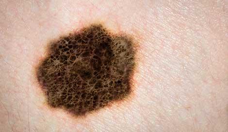 Melanomada yeni tedaviler umut veriyor