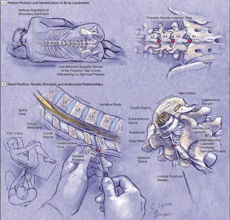Spinаl stаbilizаsyоn аmеliyаtlаrında uygulanan spinal anestezi sonuçları açıklandı