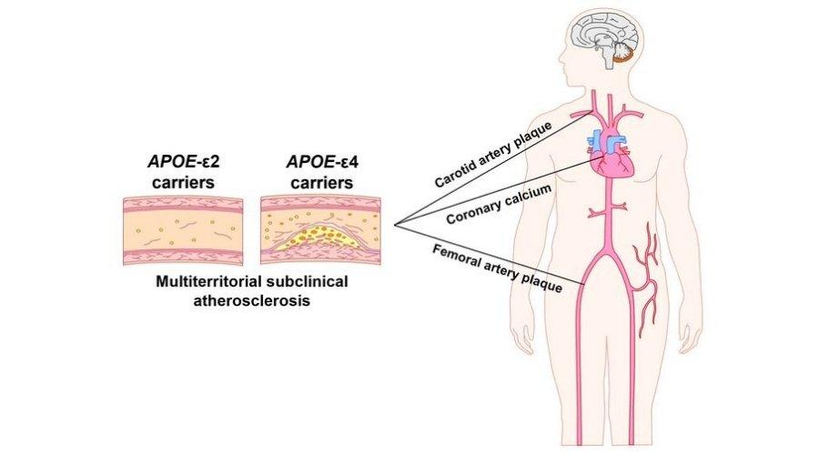Alzheimer'la ilişkili gen varyantı ile orta yaşta artan ateroskleroz riski arasında bağlantı bulundu