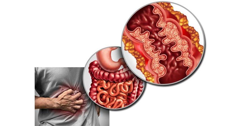 FDA orta-şiddetli Crohn tedavisi için ilk hapı onayladı