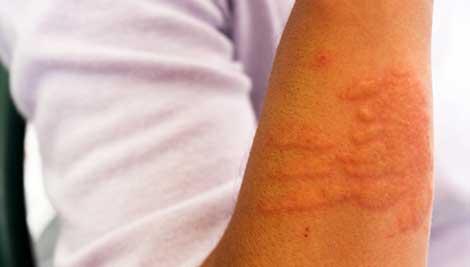 Atopik dermatitteki subklinik inflamasyonun kontrolünde takrolimus