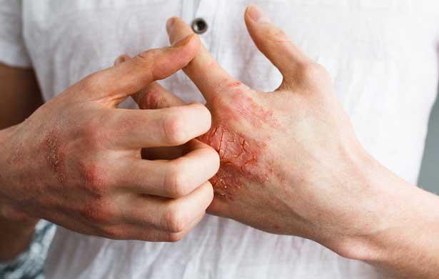 FDA, gençlerde orta-şiddetli egzama için Dupilumab'ı onayladı