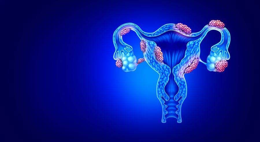 Çocukluk travması olan kadınların endometriozise yakalanma riski daha fazla olabilir