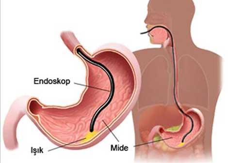 Endoskopi tarihe karışıyor!
