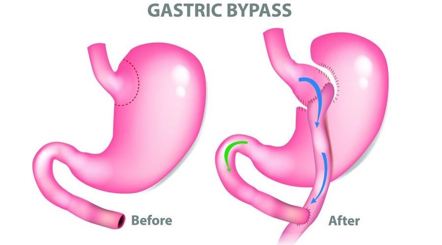 Yeni araştırma gastrik bypass ameliyatının uzun vadeli etkinliğini sorguluyor