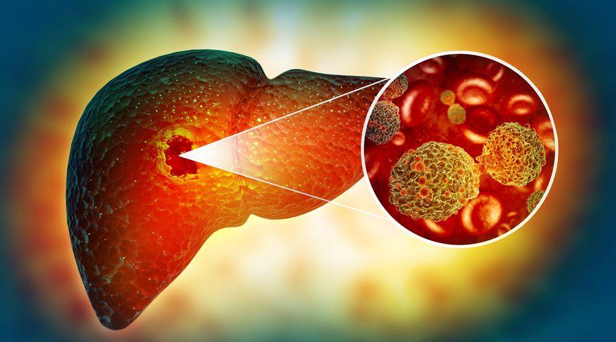 Statin kullananlarda karaciğer kanseri riski azalıyor