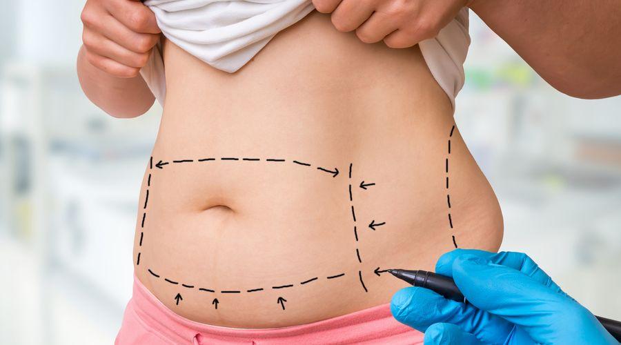 Karın germe estetiği hakkında en sık sorulan 10 soru