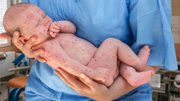 Kızamık salgınını artıran 8 yanlış bilgi: Vakalar yüzde 74 arttı 