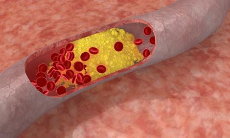 FDA'dan kolesterol iğnesine onay