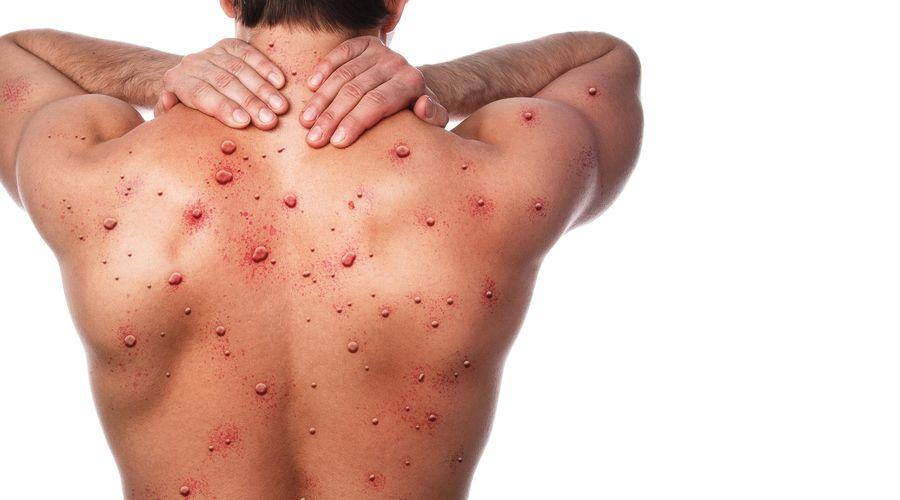 ABD'nin 'maymun çiçeği virüsü' planı: Aşılamaya hız veriliyor