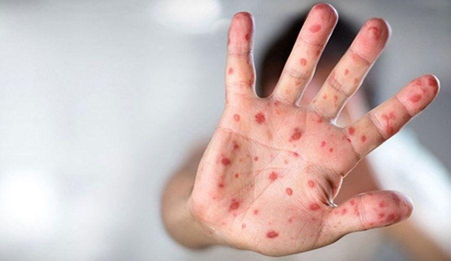 Maymun çiçeği, COVID-19 ve HIV’in aynı anda bulunduğu vaka tespit edildi
