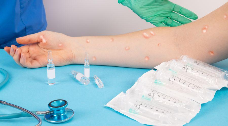 Sağlık Bakanlığı, 'M çiçeği' hastalığına ilişkin merak edilen 11 soruyu yanıtladı