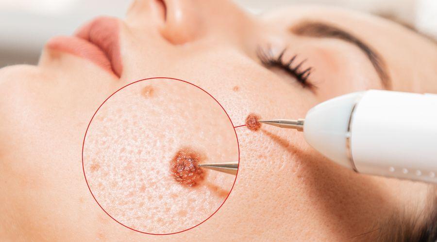 Araştırma: Melanom dışı cilt kanseri melanomdan daha yaygın