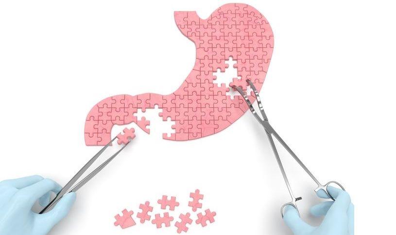 Bariatrik cerrahi, obezitesi olan kişilerde bilişsel gerilemeyi yavaşlatabilir