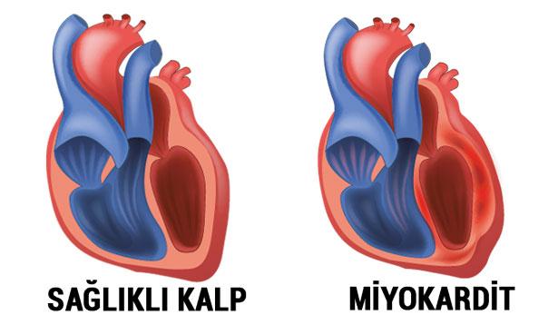 FDA, mRNA aşılarına Miyokardit uyarısı ekleyecek