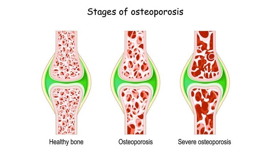 Erkeklerde osteoporoz gittikçe yaygınlaşıyor