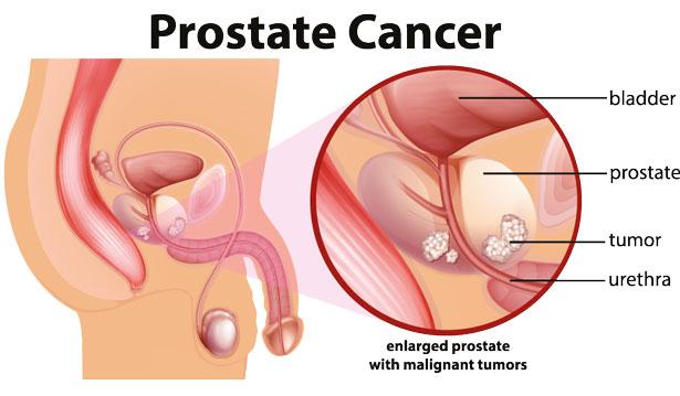 Prostat kanseriyle ilişkili olabilecek 5 bakteri belirlendi