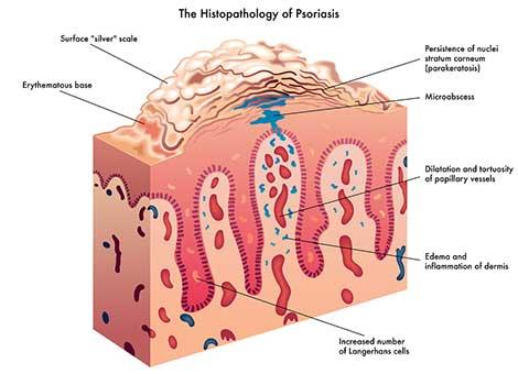 Psoriasis hastaları ne zaman romatoloji bölümüne yönlendirilmeli?