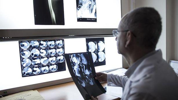Alzheimer hastalığındaki keşif, yeni tedavi yöntemleri için umut oldu