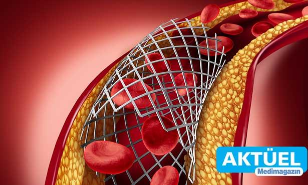 Stent hakkında merak edilenler
