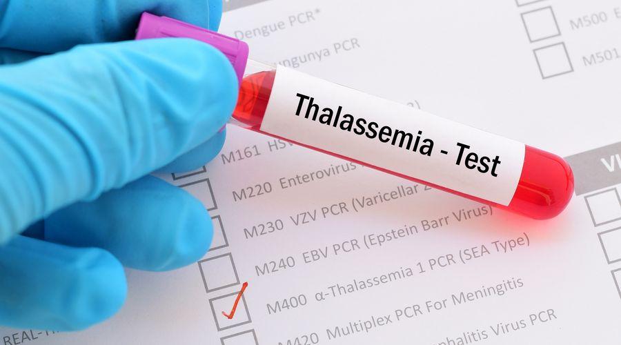 Talasemide geç tedavi en sık kalp hastalığından ölüme neden oluyor