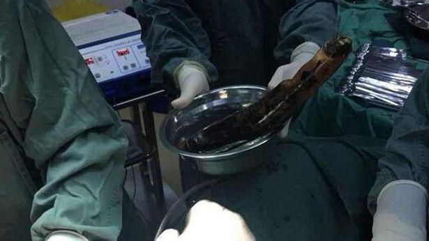 Bu tedavi yöntemi doktorları şoke etti: 30 cm'lik patlıcan