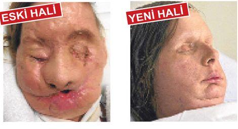 Yüz nakli sonrası ilk fotoğraf