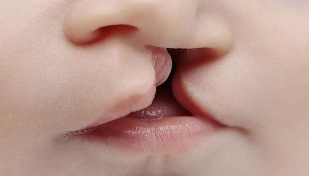 Prof. Dr. Zekeriya Tosun: Yıllık ortalama 2 bin 500 dudak ve damak yarıklı bebek doğuyor