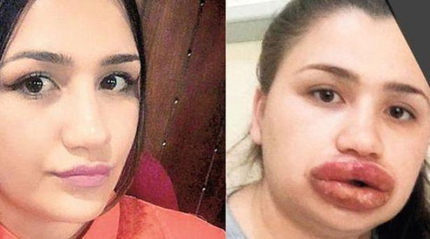 Dudak dolgusu yaptıran hemşire dudaklarını kaybetme tehlikesi yaşıyor
