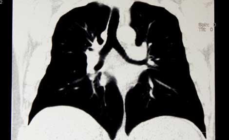 Sigara içmeyenlerde de akciğer kanseri görülme oranı artıyor
