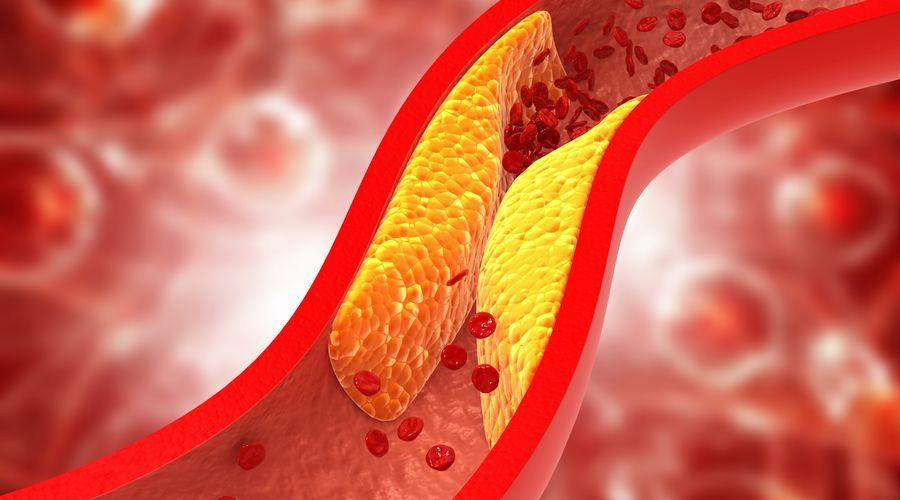 Yüksek 'iyi kolesterol' seviyeleri yaşlı yetişkinlerde demans riskinin artmasıyla bağlantılı
