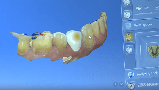 Diş tedavisinde 3 boyutlu yazıcılar dönemi: Yeni diş dakikalar içinde monte ediliyor
