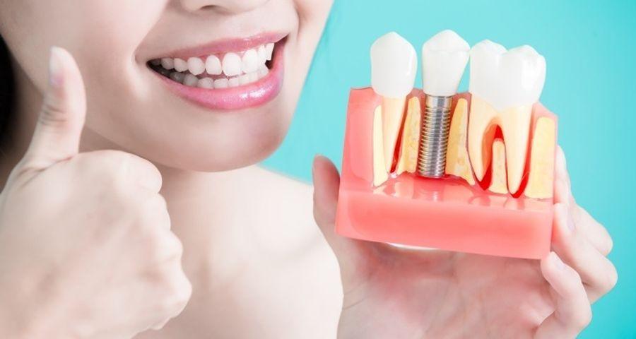 3 çeşit diş implantı: Hangisi sizin için en iyisi?