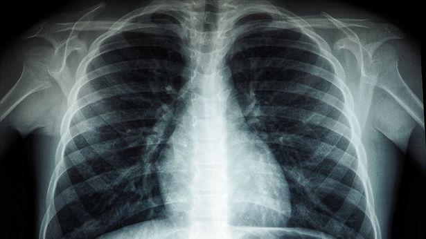 Düşük maliyetli bir ilacın COVID-19 hastalarında akciğer zararını sınırladığı belirlendi
