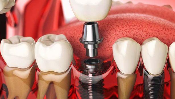 Dental implant tedavisi süreci nasıl işler?