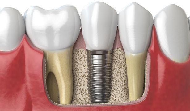 İmplant diş tedavisinde izlenen adımlar nelerdir?