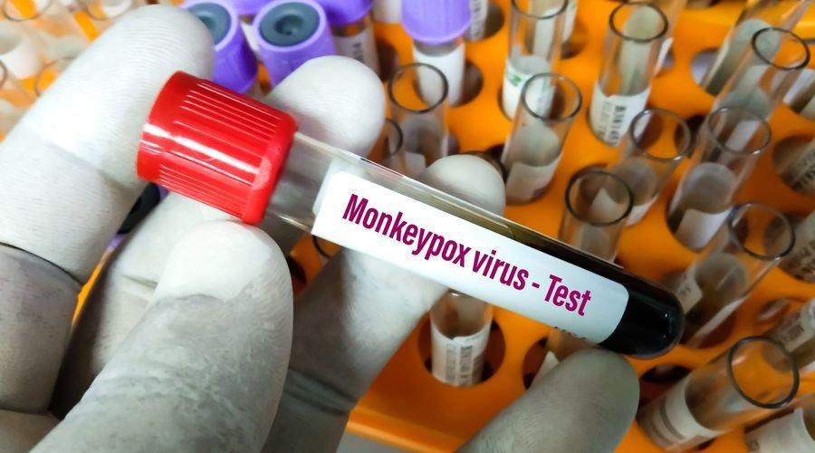 Uşak Sağlık Müdürlüğünden 'Maymun çiçeği virüsü görüldü' iddialarına yanıt: Test sonucu negatif çıkmıştır