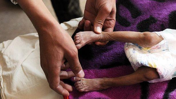 Yemen'de difteri salgını artıyor