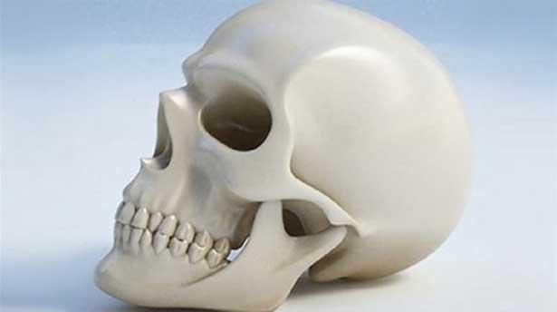 3 boyutlu kafatası implantı geliştirildi