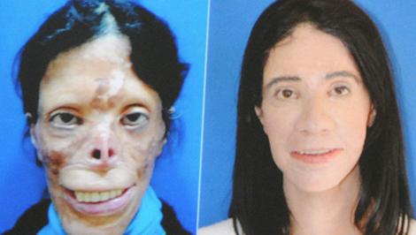 Gaziantepli doktor nakil olmadan yeni yüz yaptı