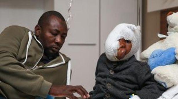 Somalili çocuk yüzünün yarısını kaplayan tümörden Türk hekimlerinin desteği ile kurtulacak